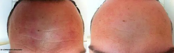 Botox Azzalure : une solution efficace et durable pour un front plus net et plus lisse! Résultats naturels pour 6 mois.