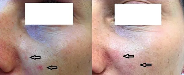 Le Centre Murano met à votre disposition le laser Vasculaire YAG dernière génération.